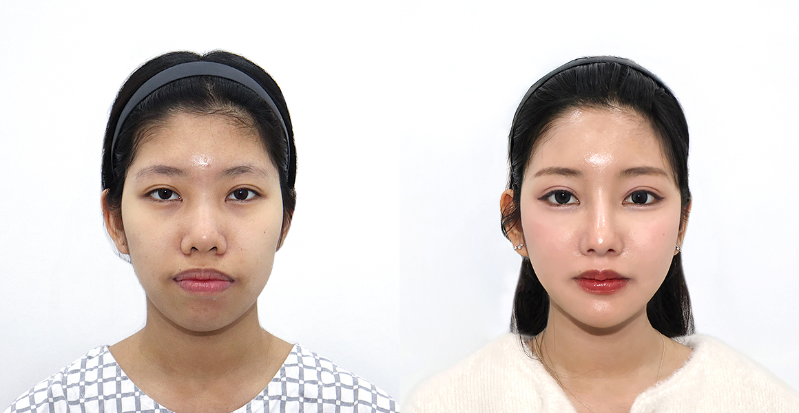 안면윤곽 전후사진 수술후기