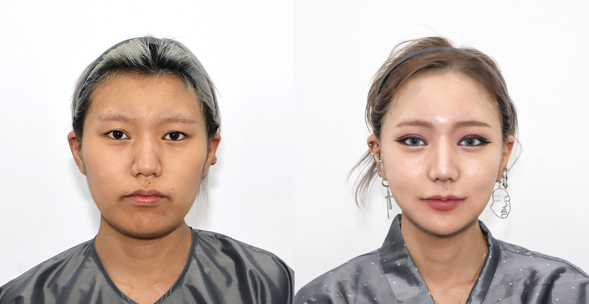 안면윤곽 전후사진 수술후기
