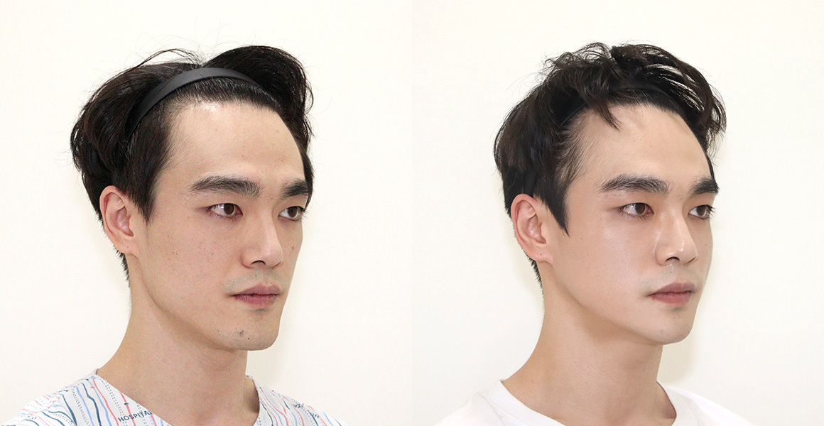 안면윤곽 전후사진 수술후기