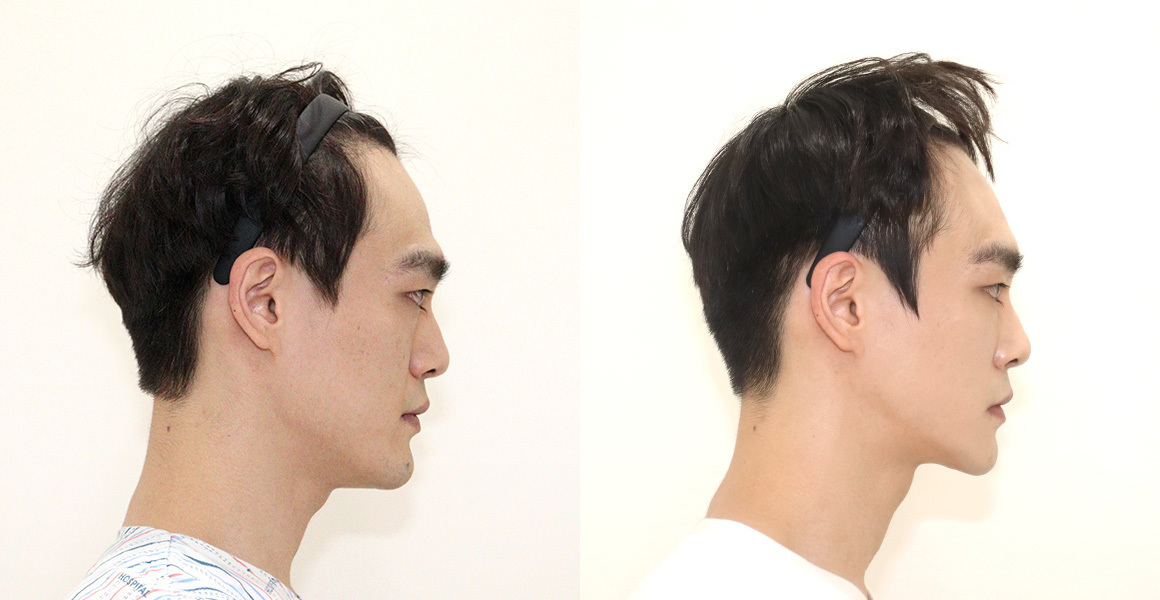 안면윤곽 전후사진 수술후기