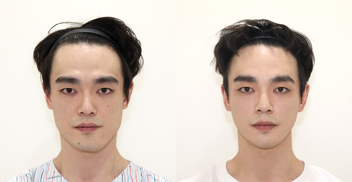 안면윤곽 전후사진 수술후기