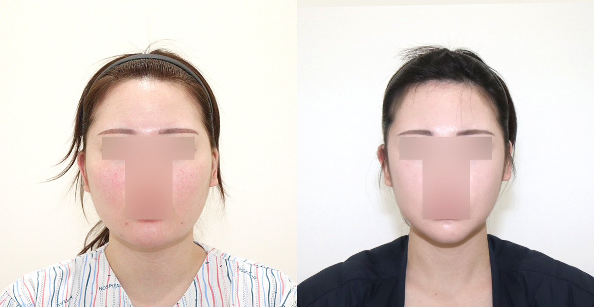 【裁断済み】Aesthetic Plastic Surgery 11042_2022_12865_Fig9_HTML.png