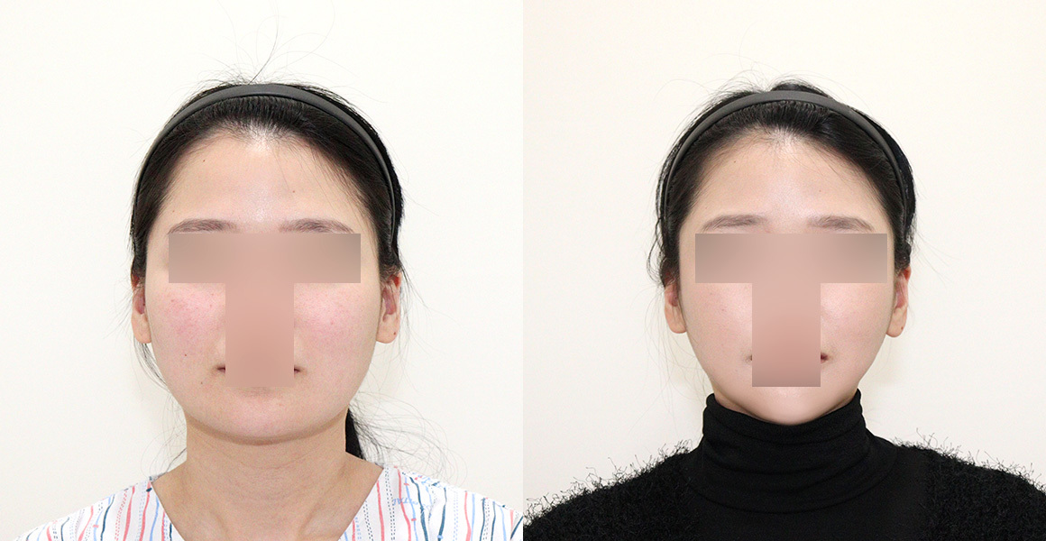 【裁断済み】Aesthetic Plastic Surgery Signature Z-Plasty Scar Revision by Dr. Hweidi after 8